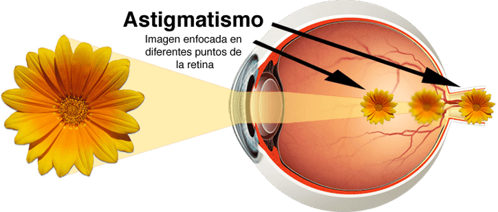 astigmatismo.png