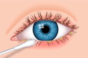 blepharitis-eye-swab-330x220