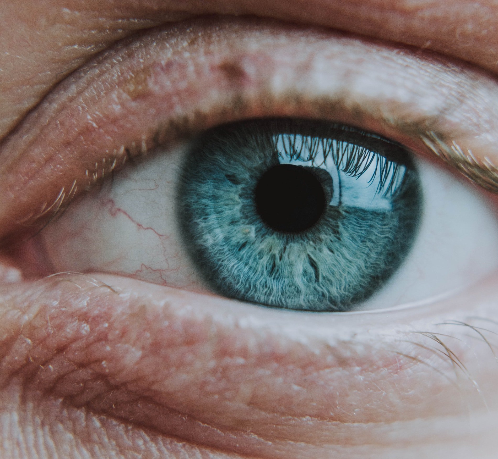 Glaucoma