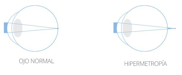 Ojo normal - Ojo hipermétrope