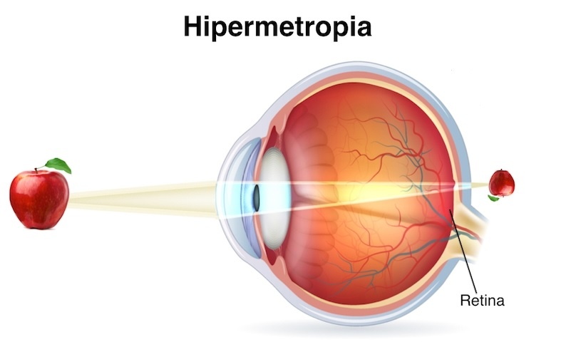 ojo-hipermetrope