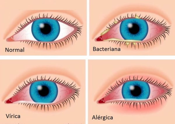 conjuntivitis