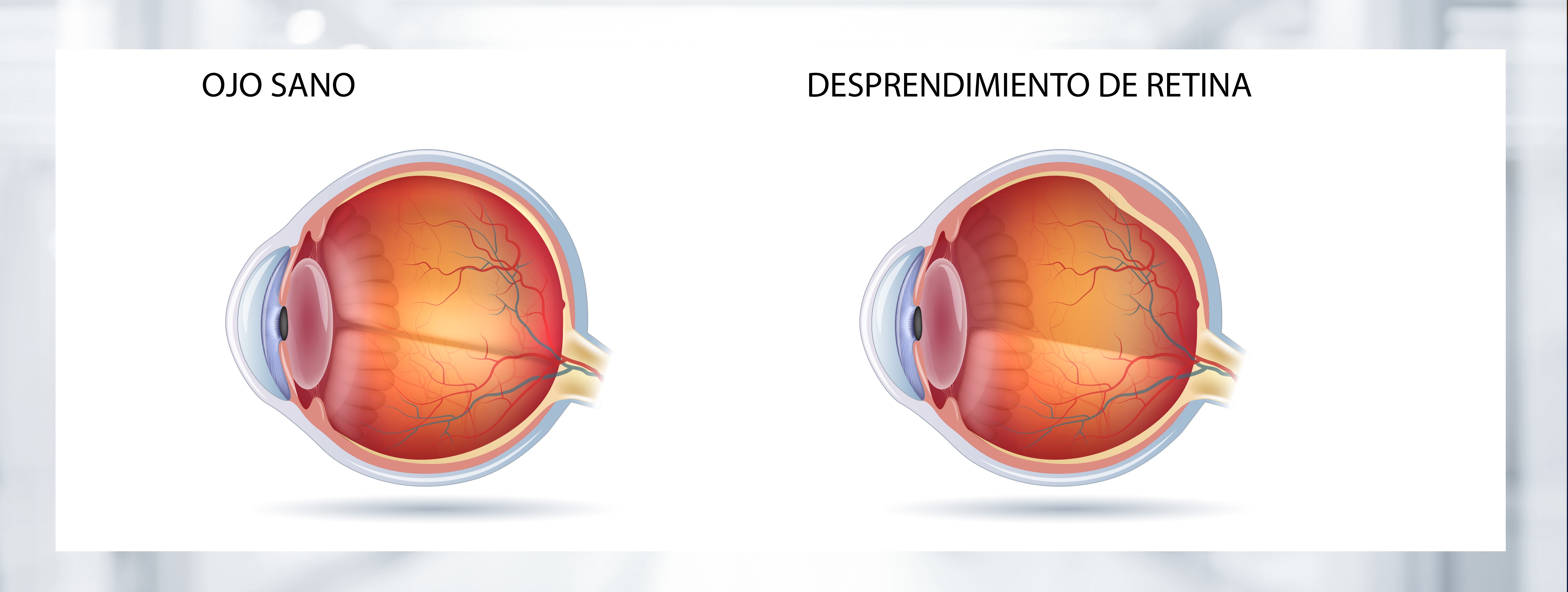 Resultado de imagen para desprendimiento de retina